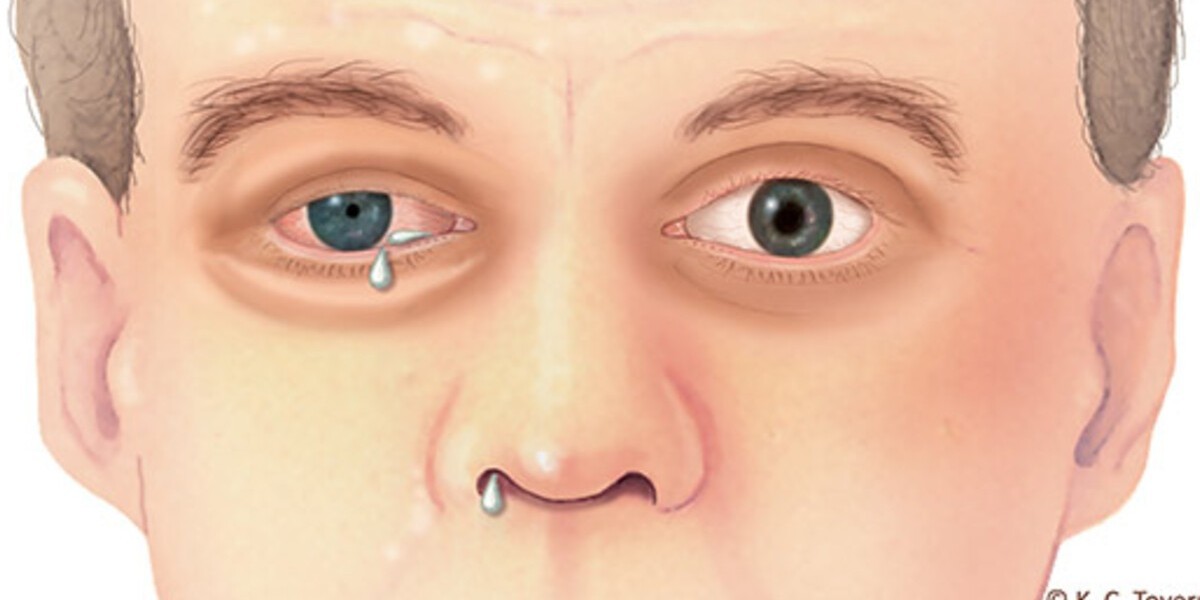 Cluster Headache Market Epidemiology, Pipeline Analysis, Treatment,  Trends, Rising Incidence & prevalence 2025-2035