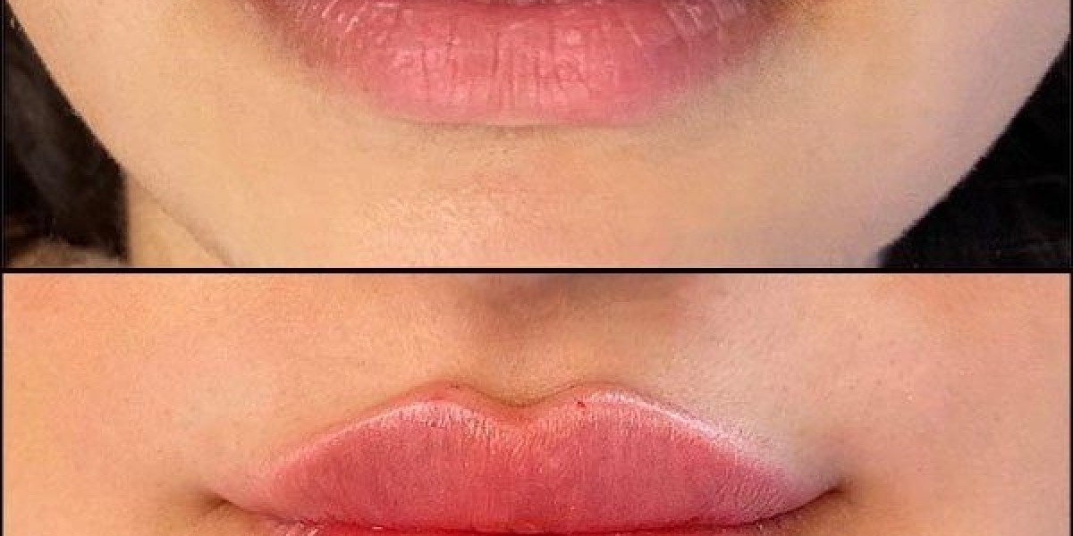 Top Trends in Lip Fillers in Riyadh