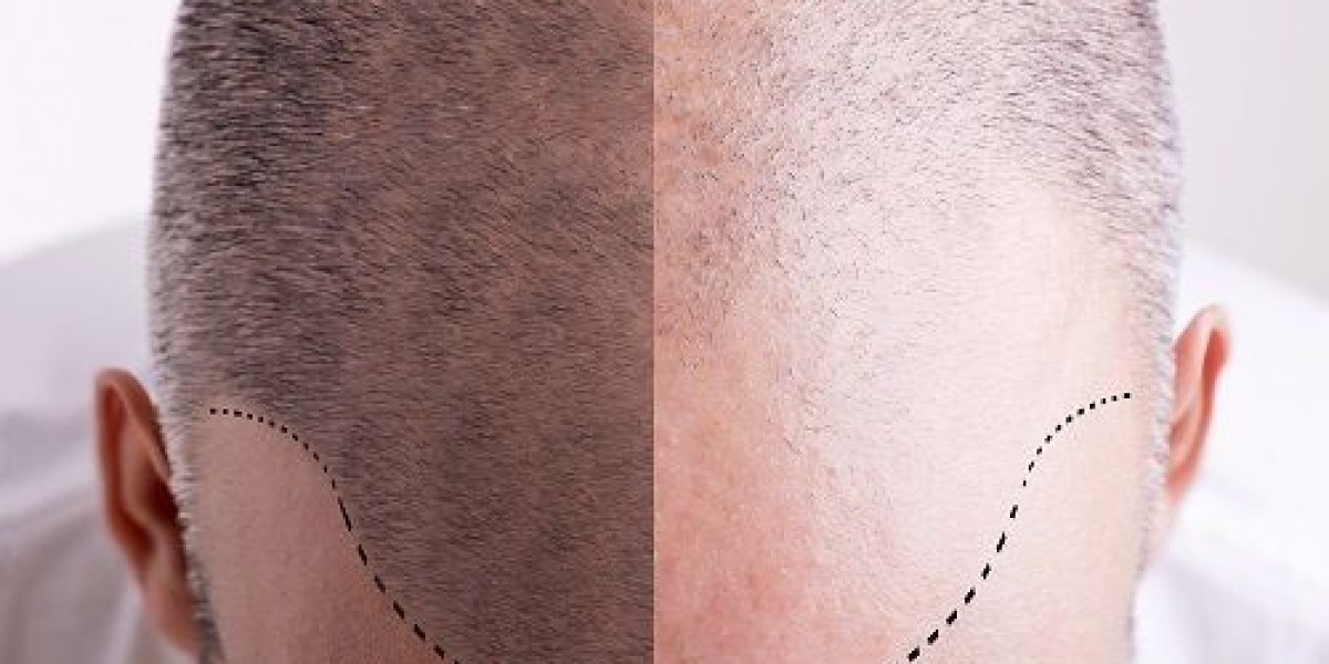 Hair Loss Treatment for Women: Top Solutions