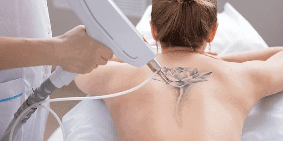 Picosure Tattoo Removal Gently Clears Tattoos Without Damage