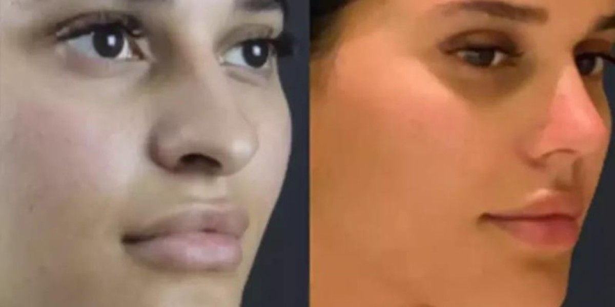 The Latest Trends in Rhinoplasty in Dubai