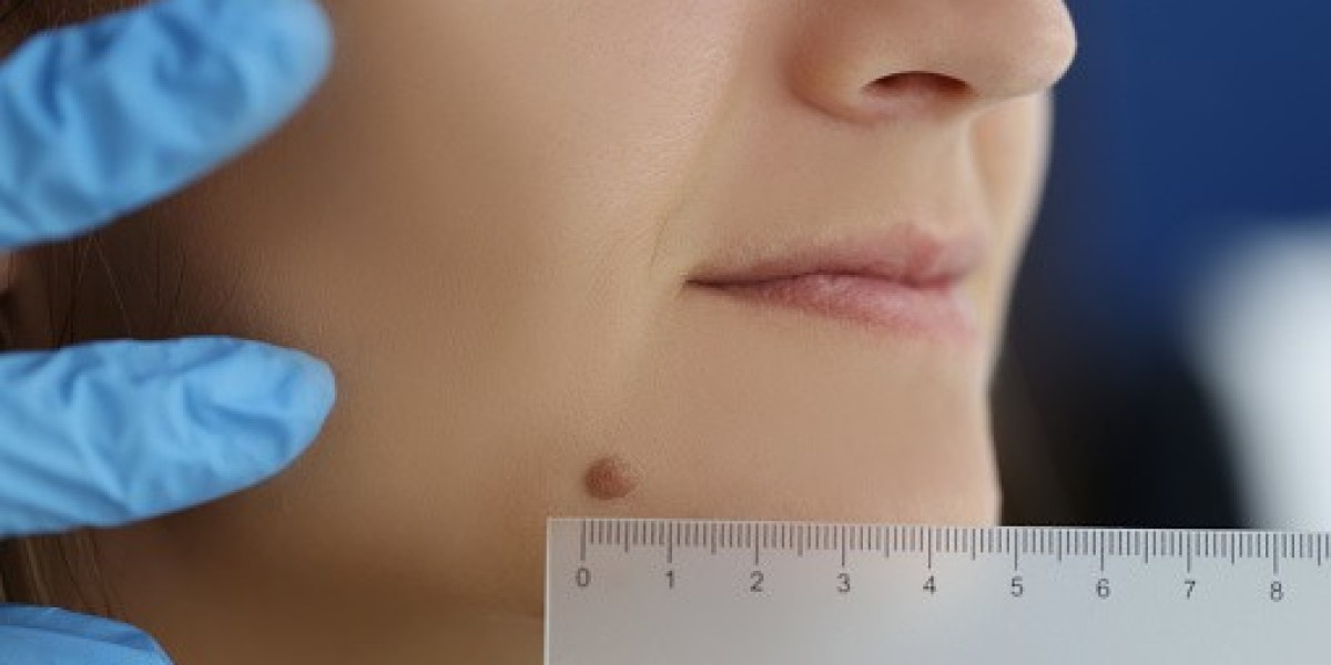 Top-Rated Birthmark Removal Services in Riyadh