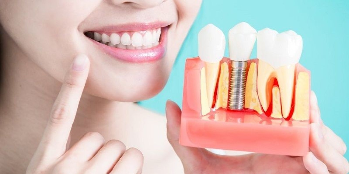 Trồng răng công nghệ implant: Bước tiến hiện đại trong phục hình răng mất