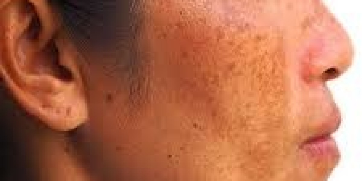 Timeless Skin Beauty Starts with Melasma Treatment in Dubai