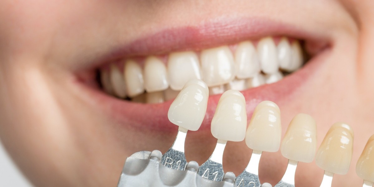 Combining E-max Veneers with Invisalign: A Complete Smile Strategy