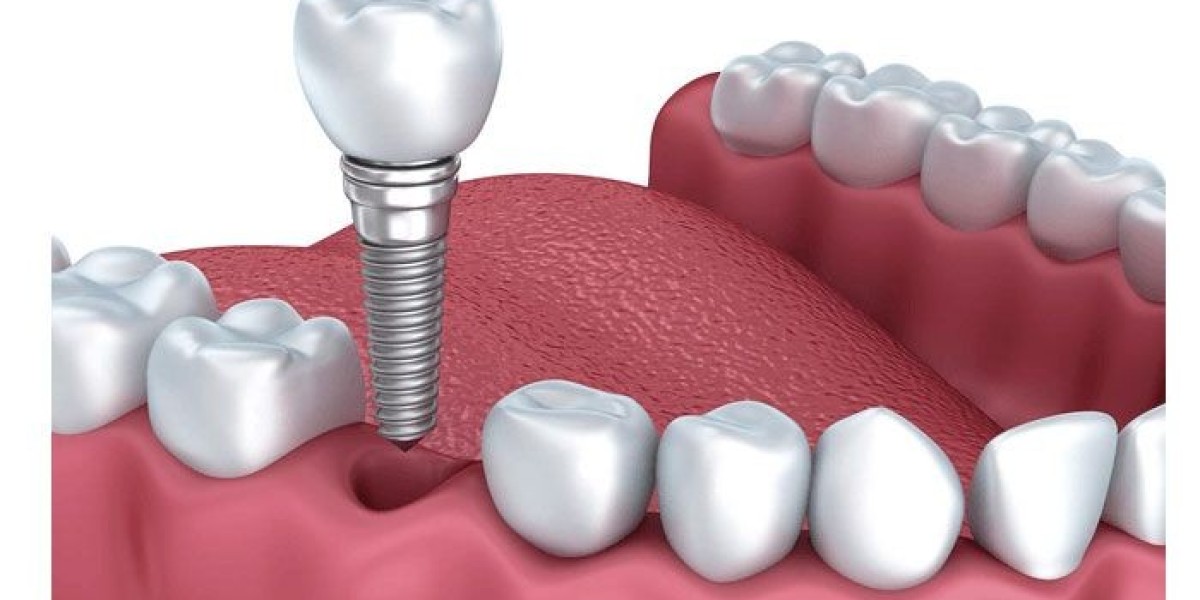 Trồng răng implant bao lâu thì xong? Cập nhật thời gian điều trị chuẩn năm 2025