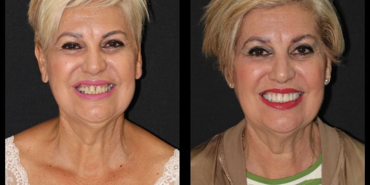 Carillas Dentales en Hospitalet de Llobregat Estética Dental de Alta Calidad