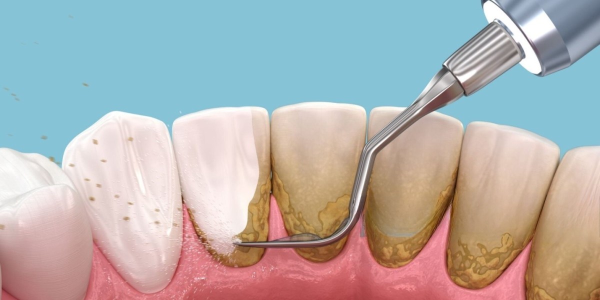 Lấy cao răng: Dịch vụ nha khoa quan trọng giúp bảo vệ sức khỏe răng miệng
