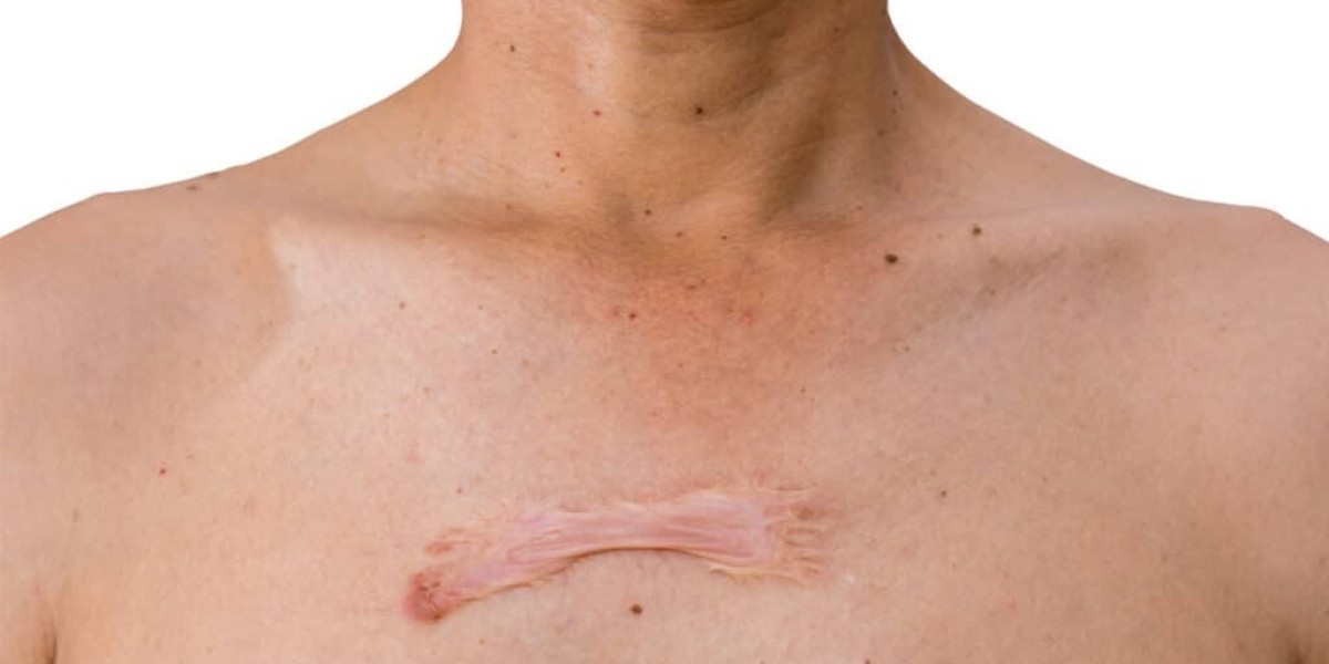 What Are Keloids and Why Do They Form?