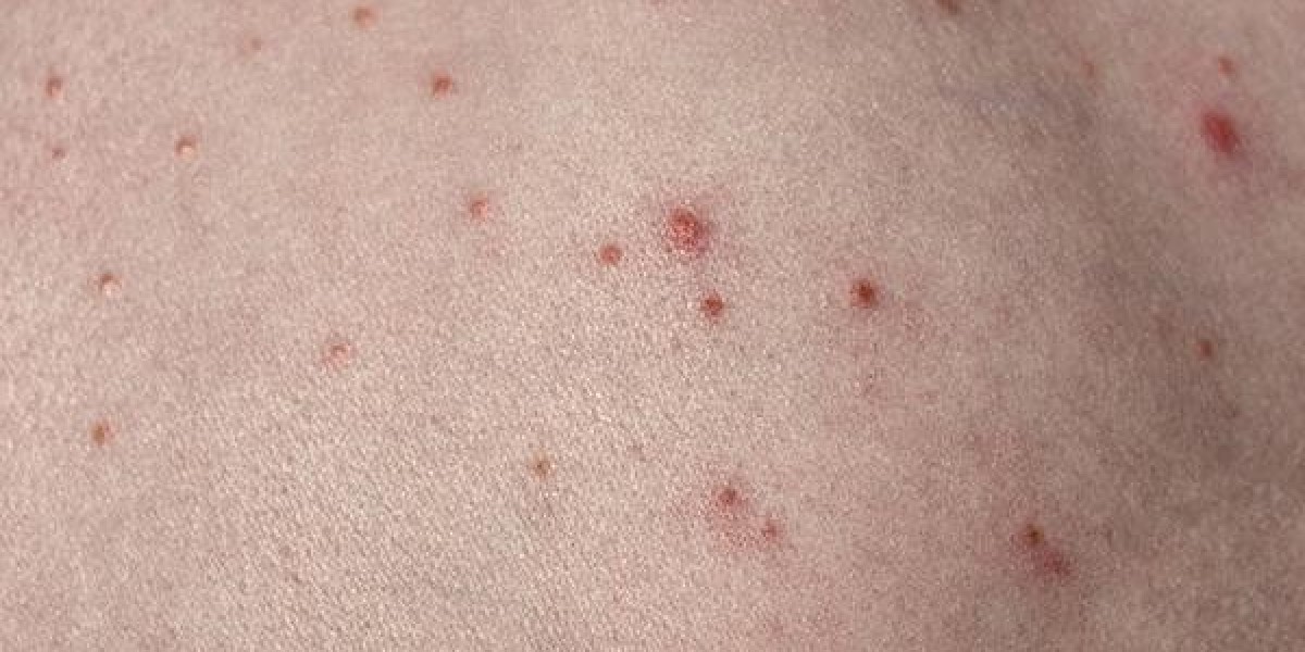 How to Treat Folliculitis with Herbal Remedies: A Complete Guide