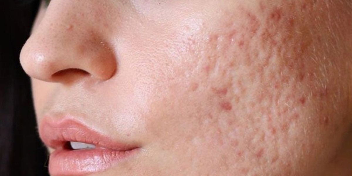 How Brad Pitt’s Acne Scar Fix Works in Dubai Now