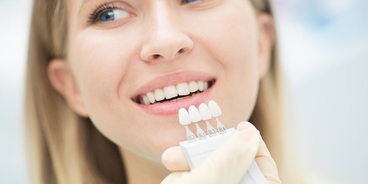 How to Prepare Your Teeth for E-max Veneers