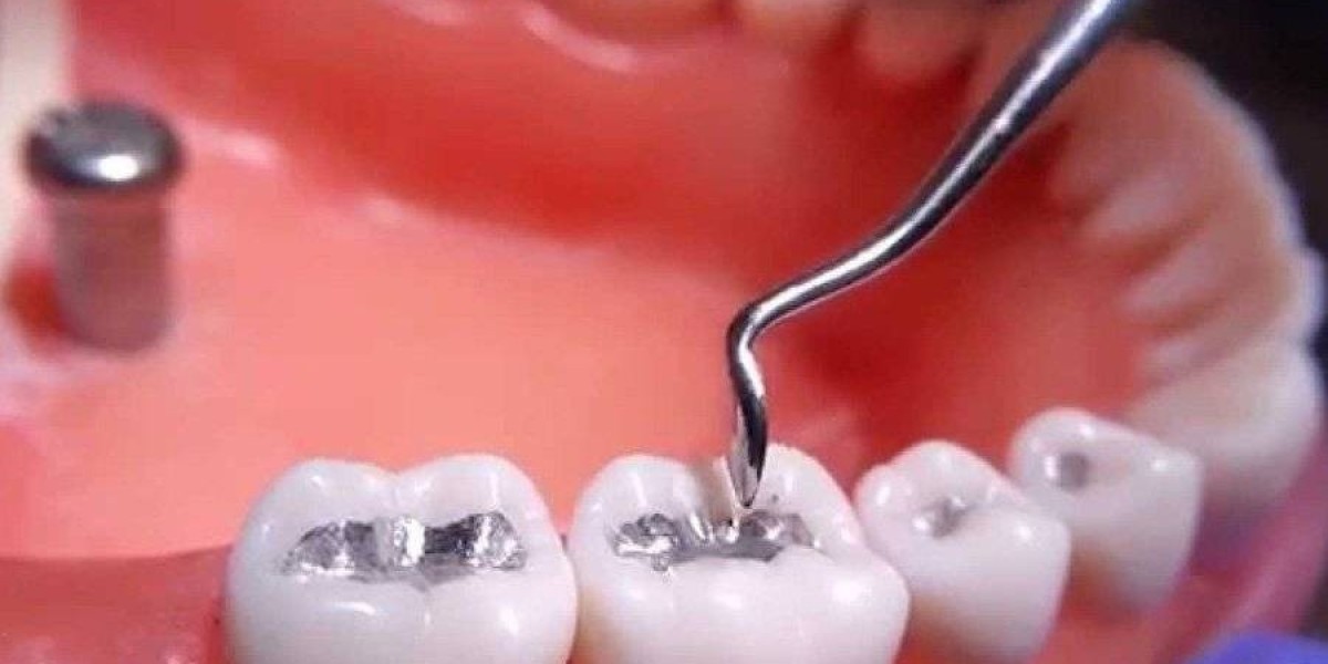 Trám răng thưa – Giải pháp thẩm mỹ đơn giản giúp nụ cười thêm hoàn hảo