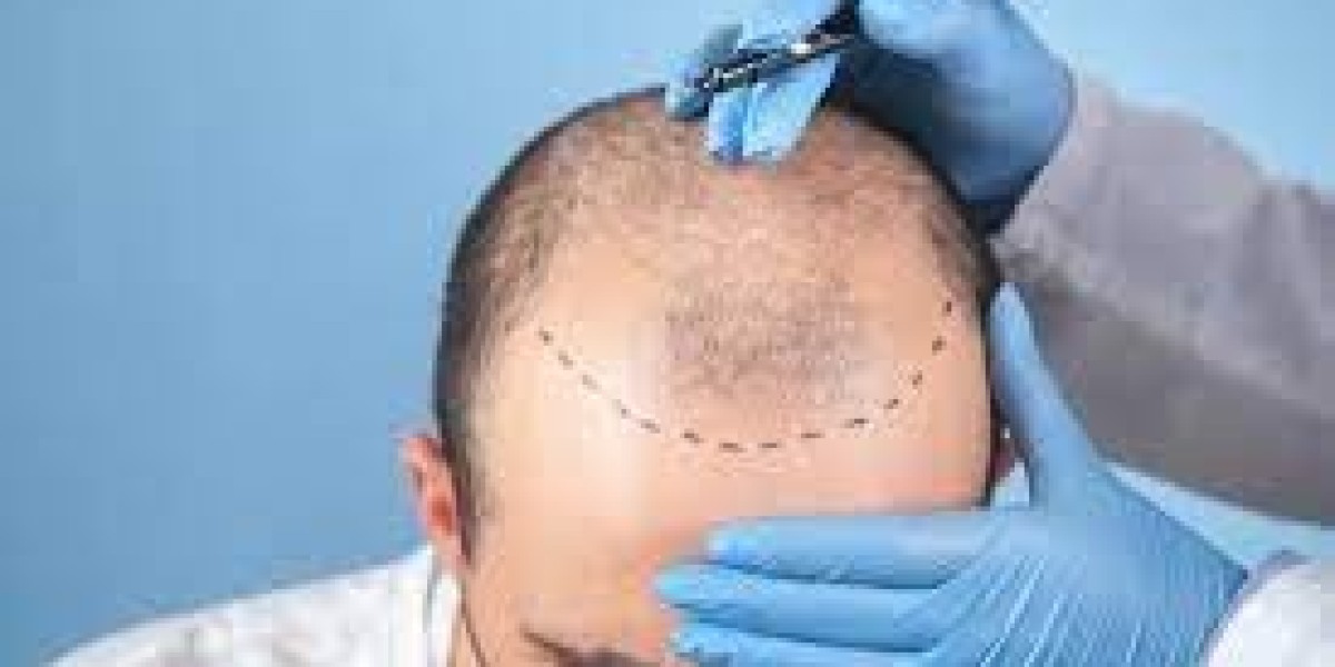 Female Hair Transplants—Natural Results in the UAE