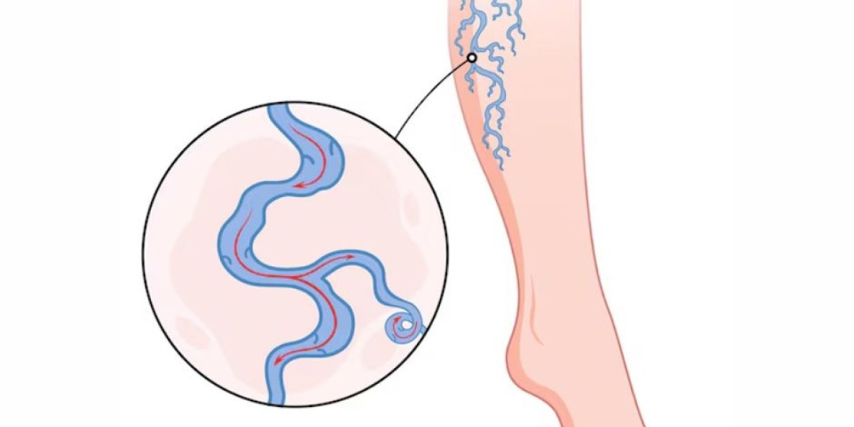 Holistic and Medical Treatments to Combat Varicose Veins
