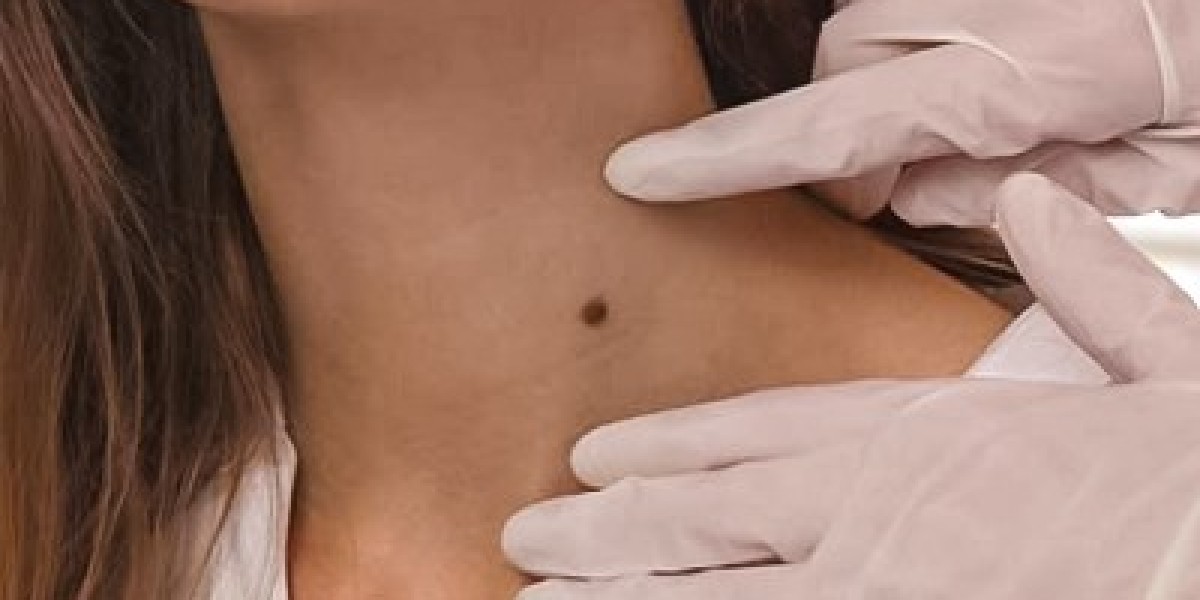 Types of Moles: Which Ones Should You Remove?