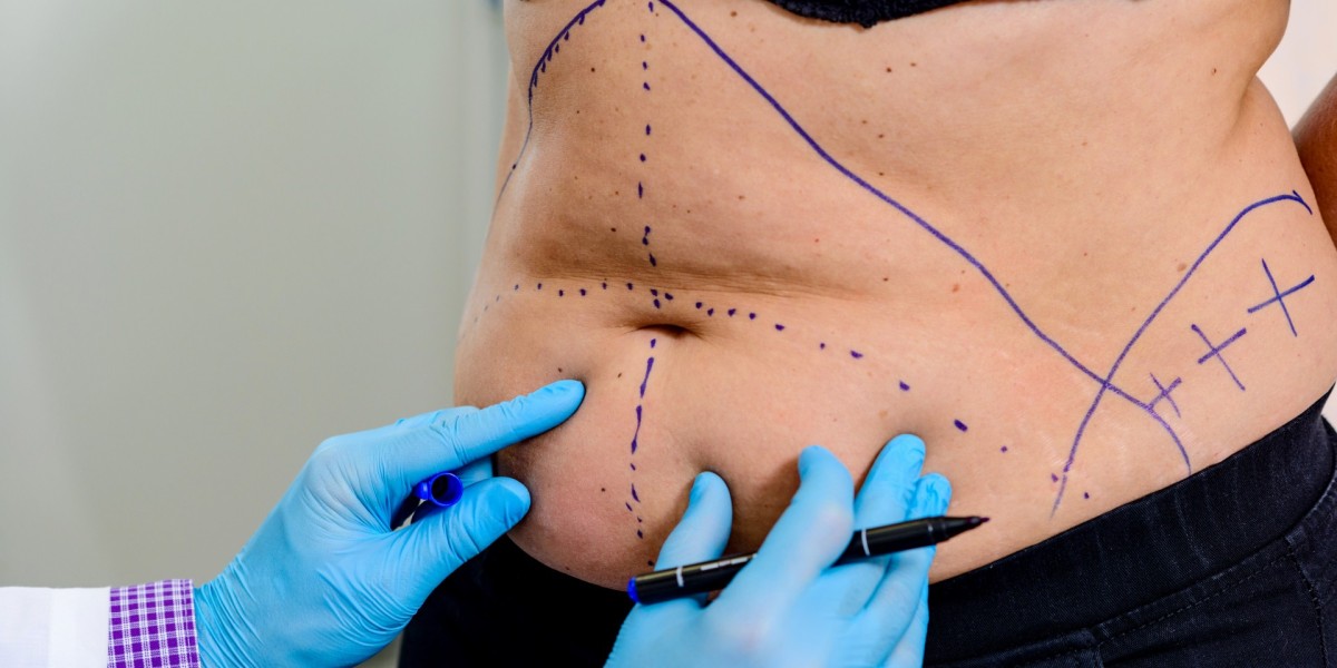 Liposuction in Dubai: Say Goodbye to Stubborn Fat for Good