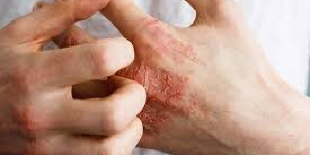 Atopic Dermatitis Market Research: Surge in Drug Approvals and Clinical Trial Successes Propel Revenue Growth