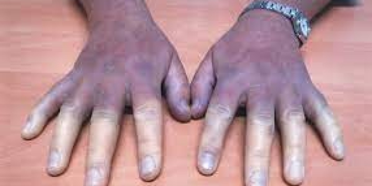 Buerger’s Disease Market: Insights, Innovations, and Future Opportunities