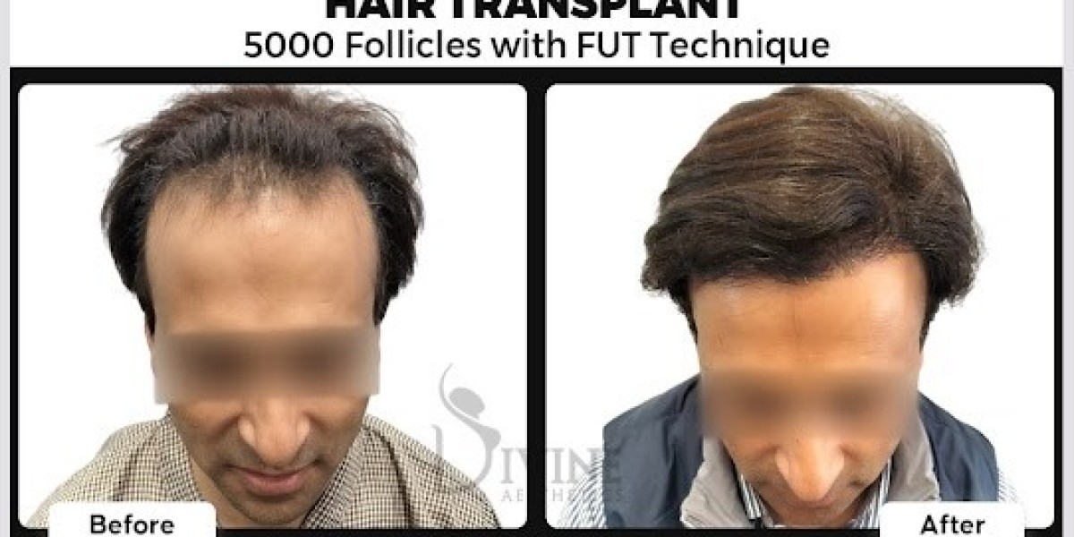 Restore Your Hair & Confidence: Affordable Hair Transplants