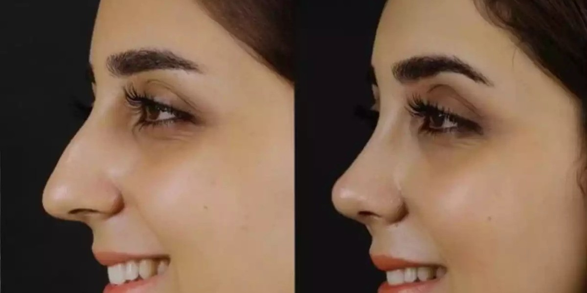 Comparing the Best Septoplasty Surgeons in Dubai: What You Should Know