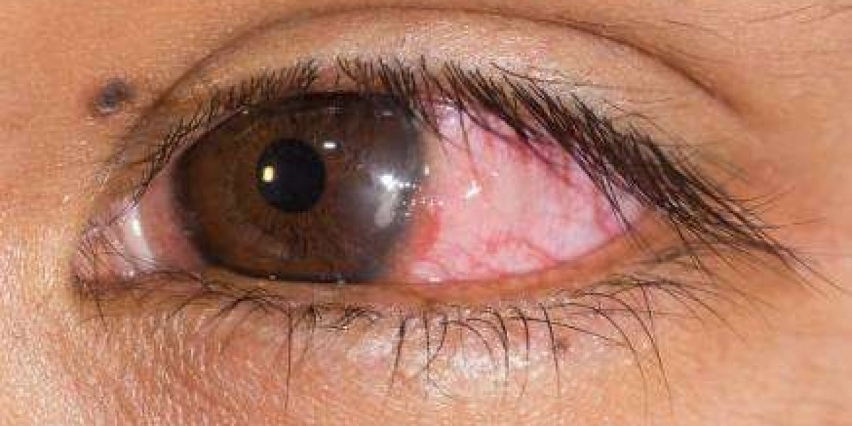 How to Treat a Bacterial Eye Infection