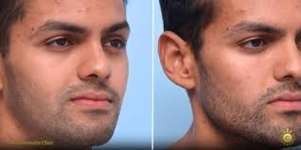 How Jawline Fillers in Dubai Enhance Facial Definition