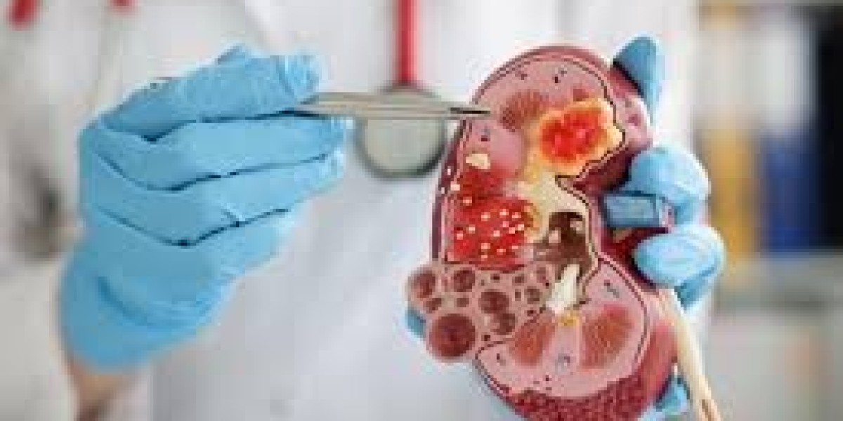 Why Timely Kidney Stones Treatment Matters for Your Health