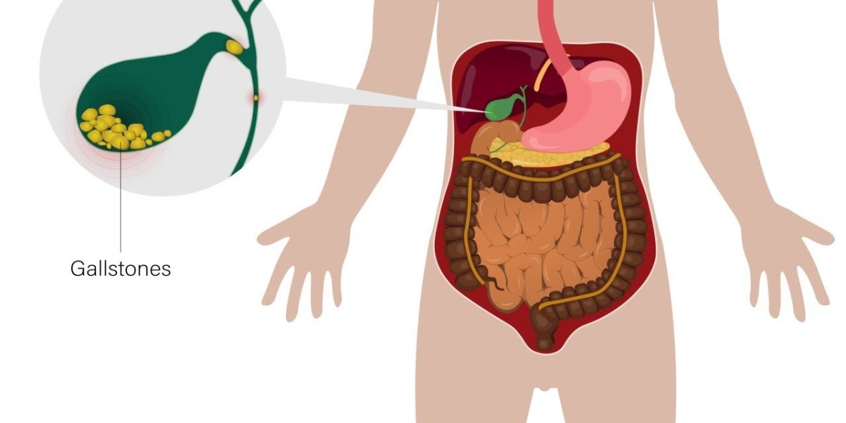 Gall-Bladder Stone Treatment in Bangalore – Causes, Symptoms & Best Options