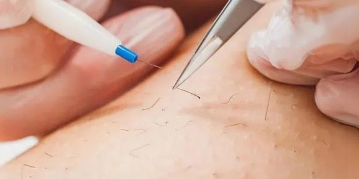Electrolysis Laser Hair Removal for Bikini Area
