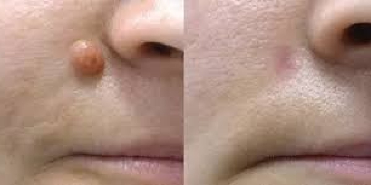 Does Mole Removal Hurt? A Realistic Look at the Experience in Dubai