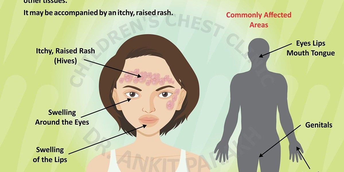 The Impact of Angioedema on Quality of Life