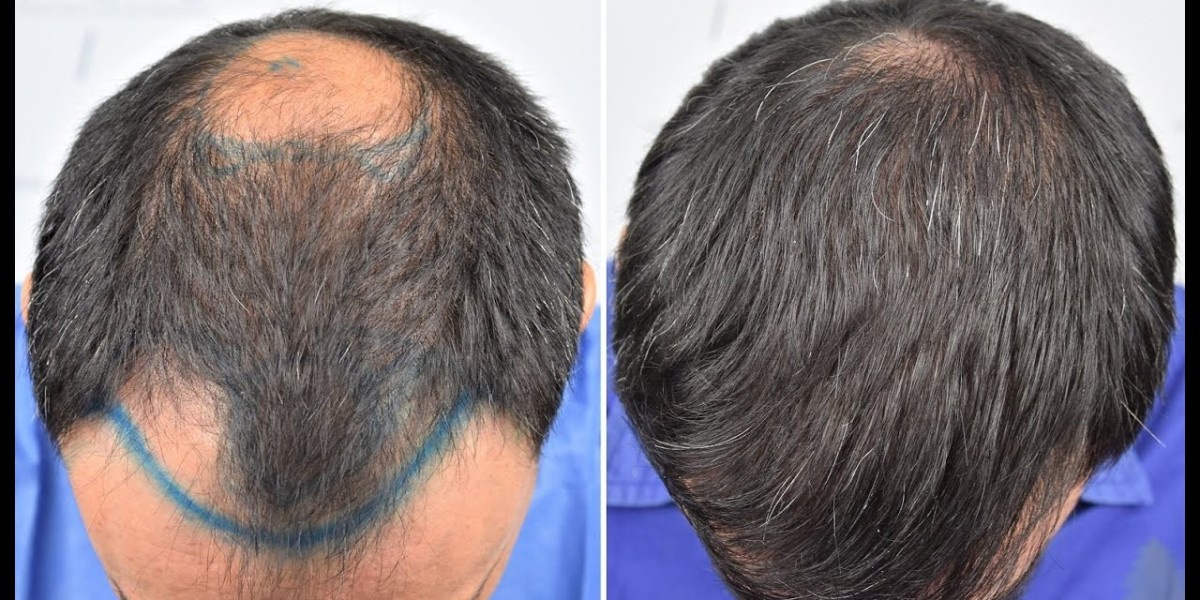 Crown Hair Loss in Young Men: When to Consider a Transplant