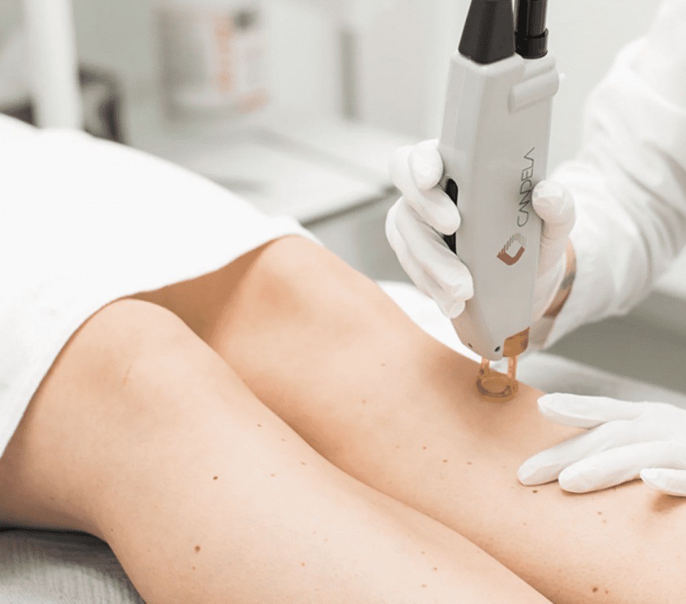Electrolysis Laser Hair Removal in Dubai