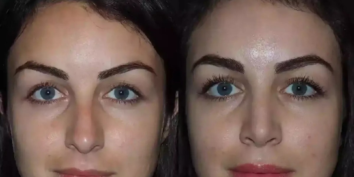 The Art of Balance: Best Rhinoplasty Surgeons in Dubai for Natural Results