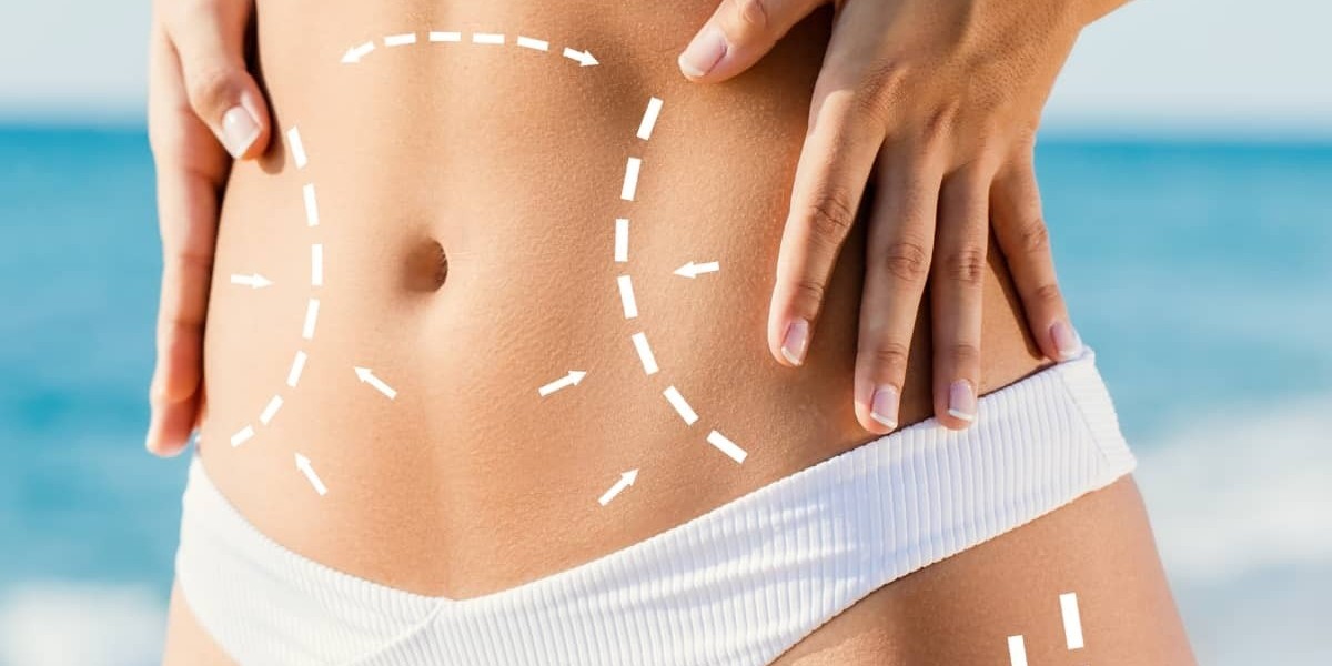 Liposuction in Dubai Is the New Era of Body Confidence