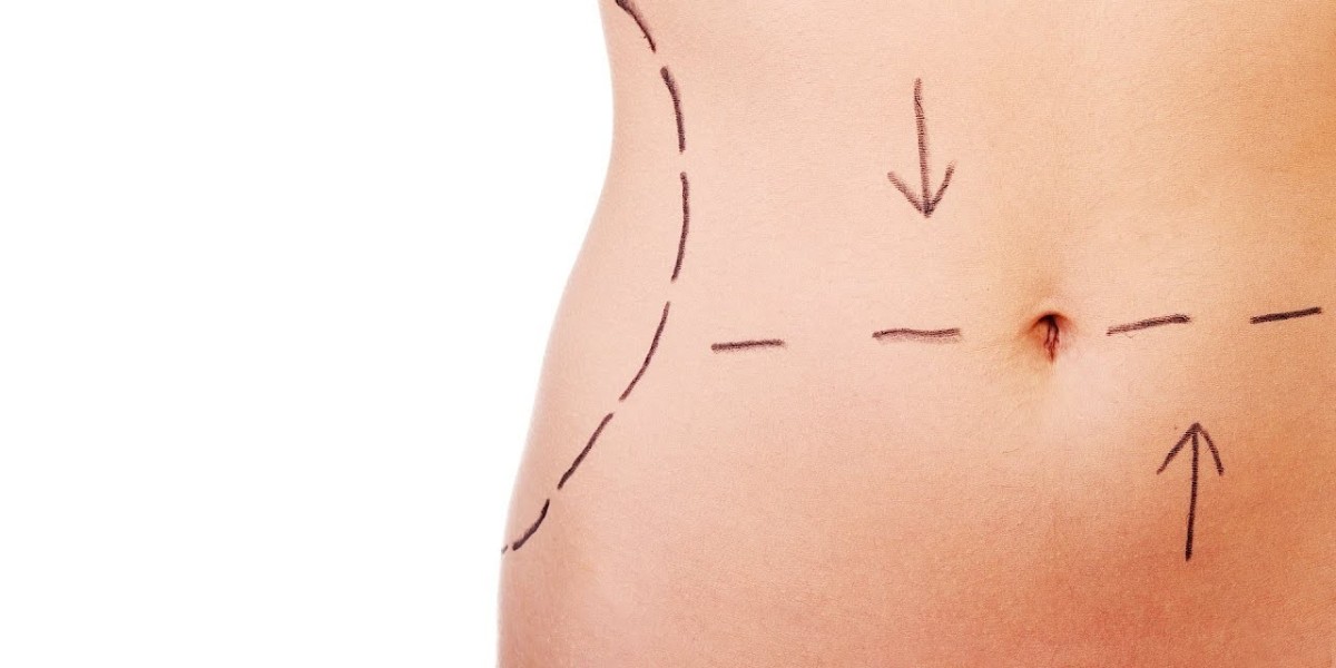 Post-Surgery Testimonials of Tummy Tuck in Islamabad