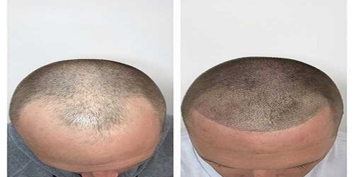 What Is Low Level Laser Hair Therapy and How Does It Work?