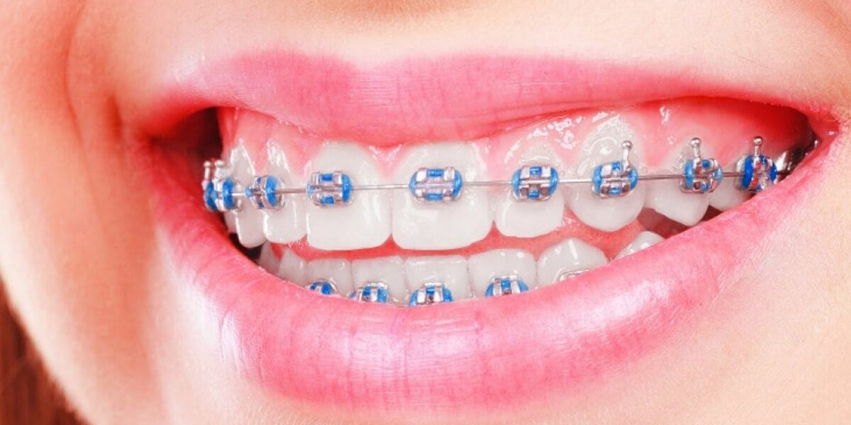 How to Make Dental Braces Cost Work With Any Budget Plan