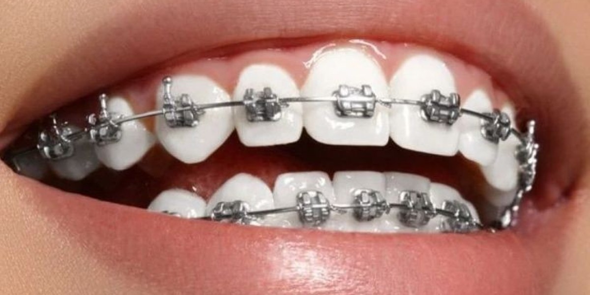 Embrace Your Best Smile: Understanding Painless Dental Braces in Riyadh