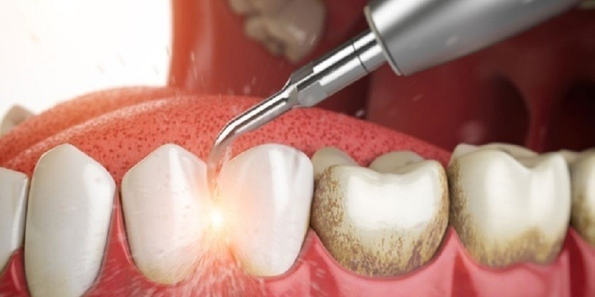 Lấy cao răng giá bao nhiêu? Tìm hiểu chi phí và lợi ích của dịch vụ