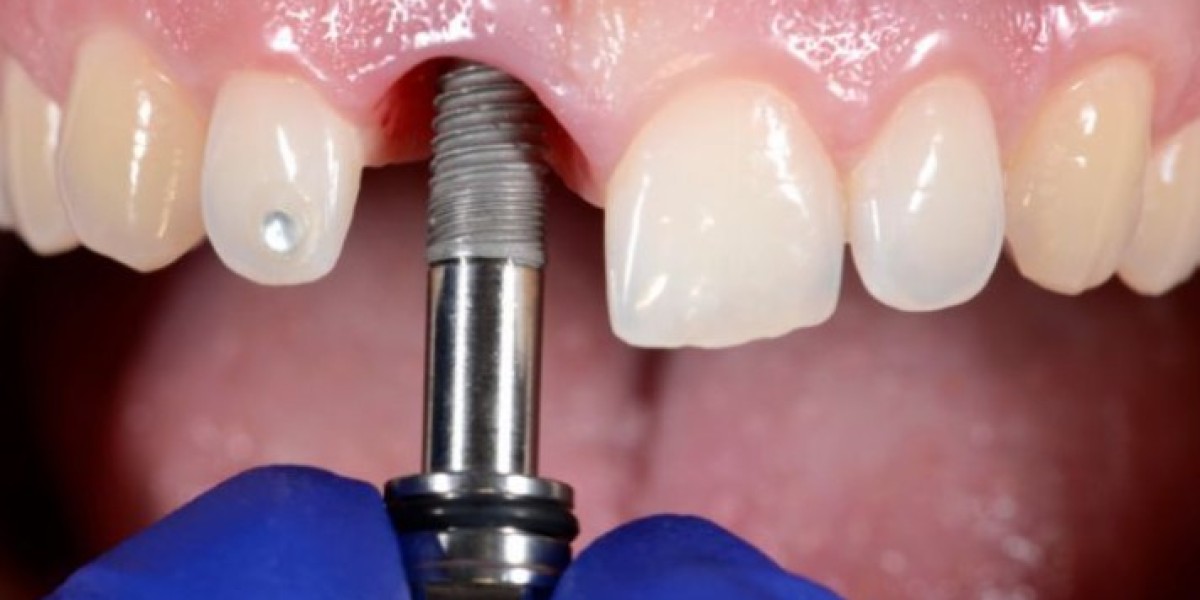 Giá lấy cao răng bao nhiêu? Chi tiết chi phí và yếu tố quyết định