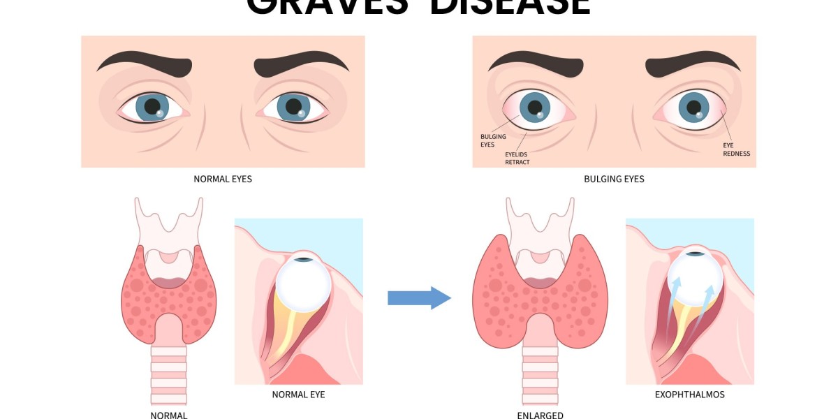 Graves' Disease Explained: What You Need to Know About This Thyroid Disorder