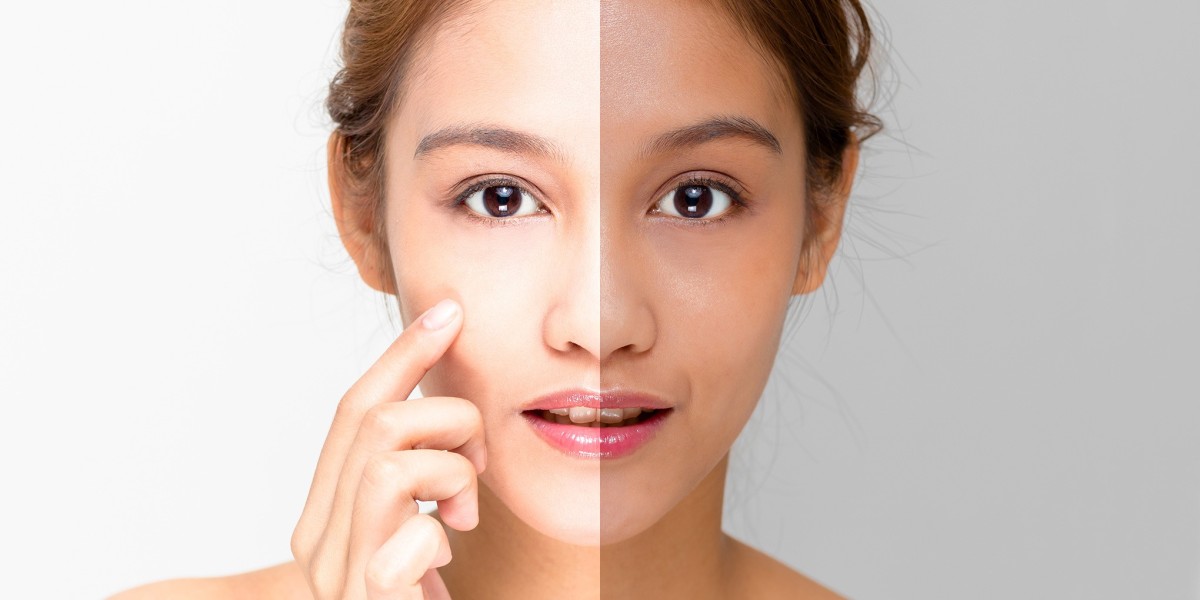 How Much Does Skin Whitening Cost in Riyadh?