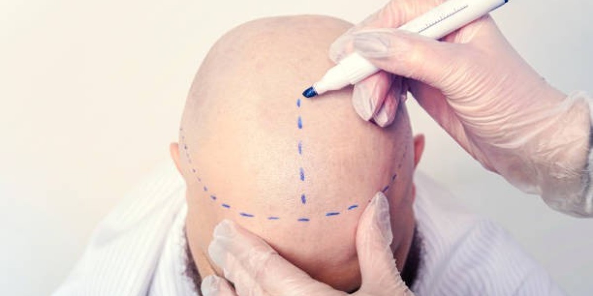 Hair Transplant Cost in Dubai: How It's Calculated
