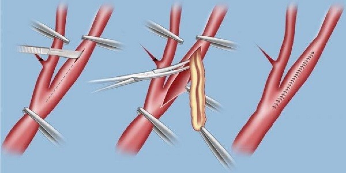 Vascular Patches Market Forecast Projects Rising Adoption Driven by Surgical Innovation and Global Health Demands