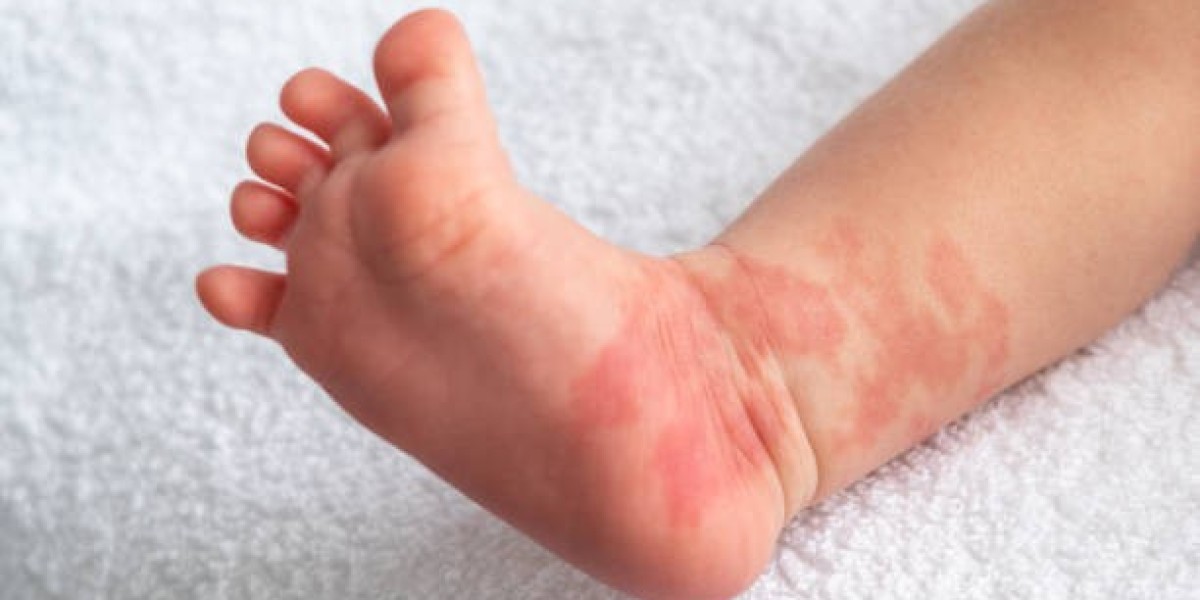 Birthmark Removal in Dubai: What Results to Expect