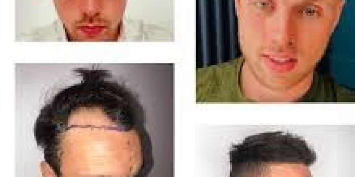 Hair Transplant in Brighton – Effective Hair Restoration Treatments for Men and Women