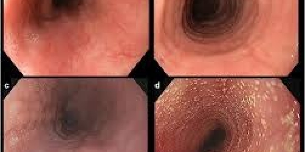 Rising Prevalence Driving the Eosinophilic Esophagitis Market Globally: Forecast 2021 - 2030