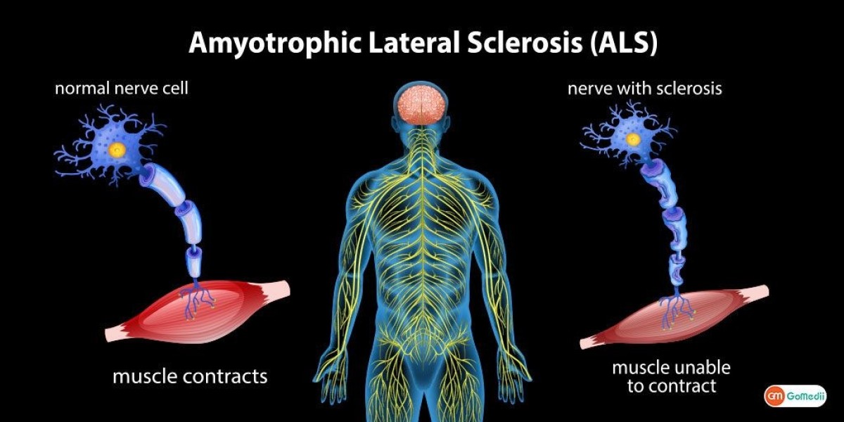 Global ALS Therapeutics Market Outlook: Growth, Innovations, and Forecast 2021 – 2030